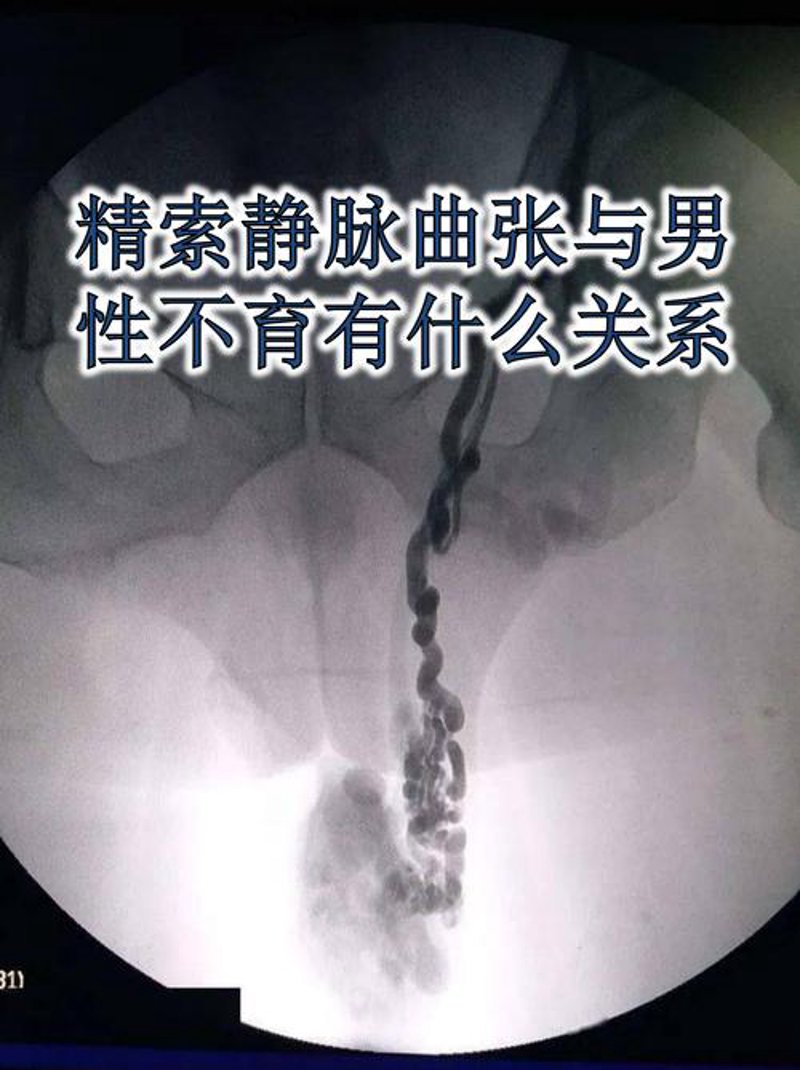 精索静脉曲张
