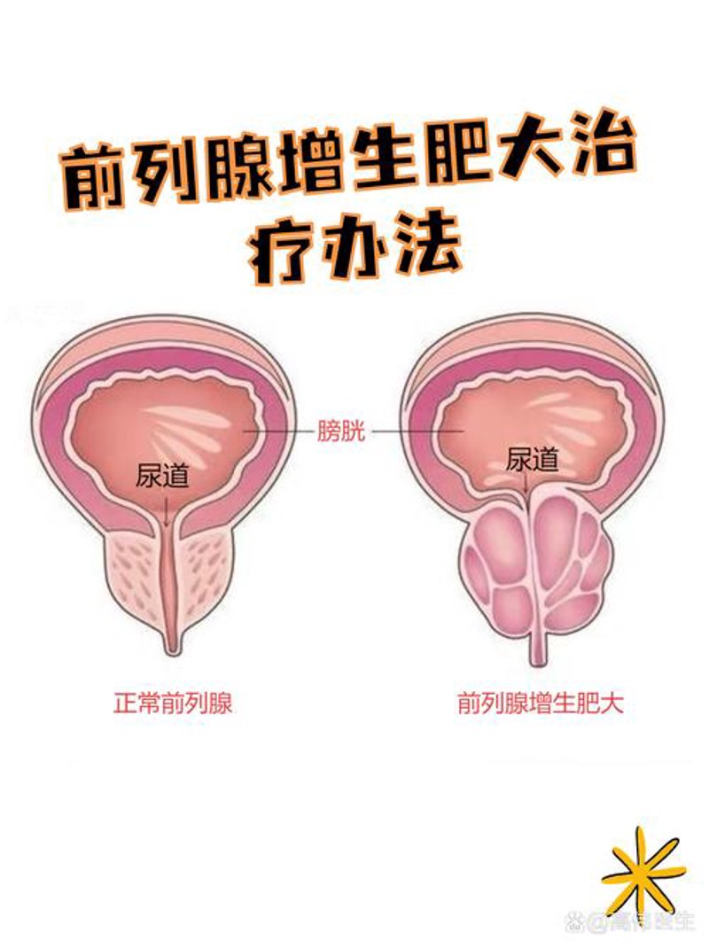 前列腺增生